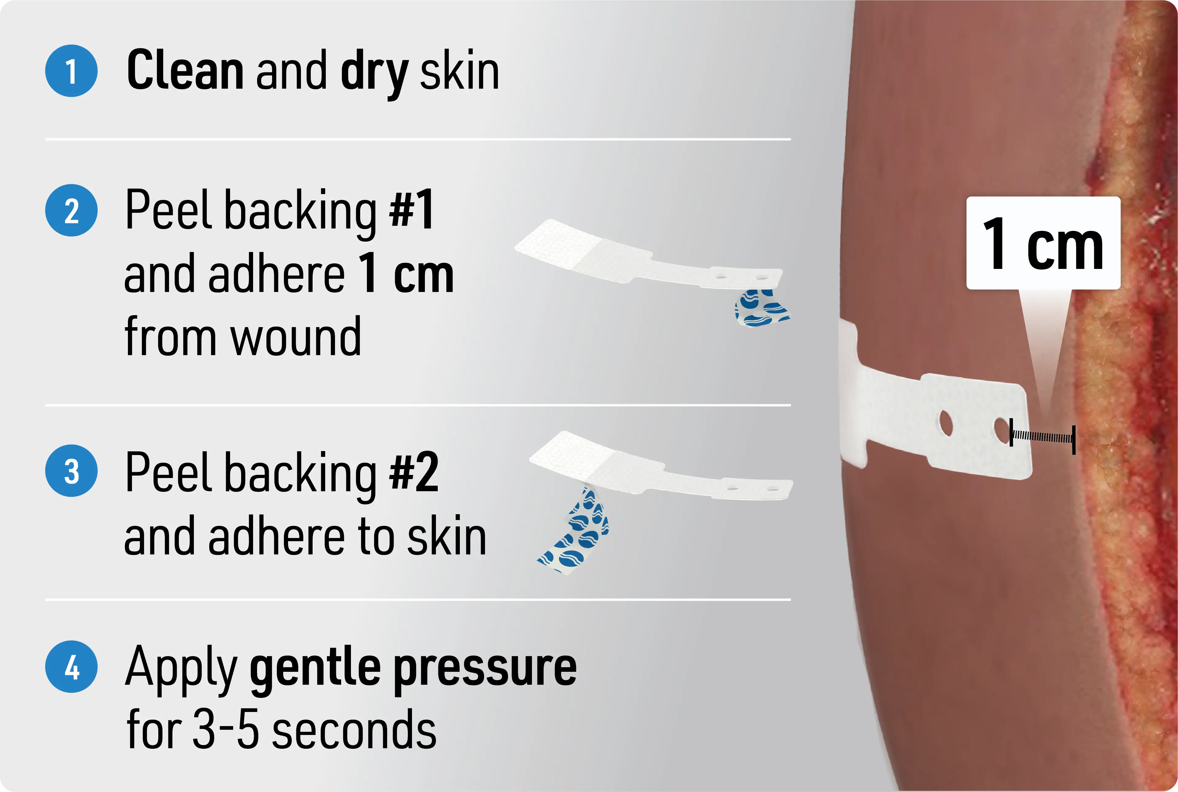 How to apply ASRD in four steps: 1) Apply to dry skin with no prep solution; 2) Place strips at least 1 cm from the wound edge and hold firm pressure for 3–5 seconds; 3) Use non-absorbable nylon 2-0 suture with a full-thickness bite through the device holes; 4) Close the remaining wound with your method of choice.
