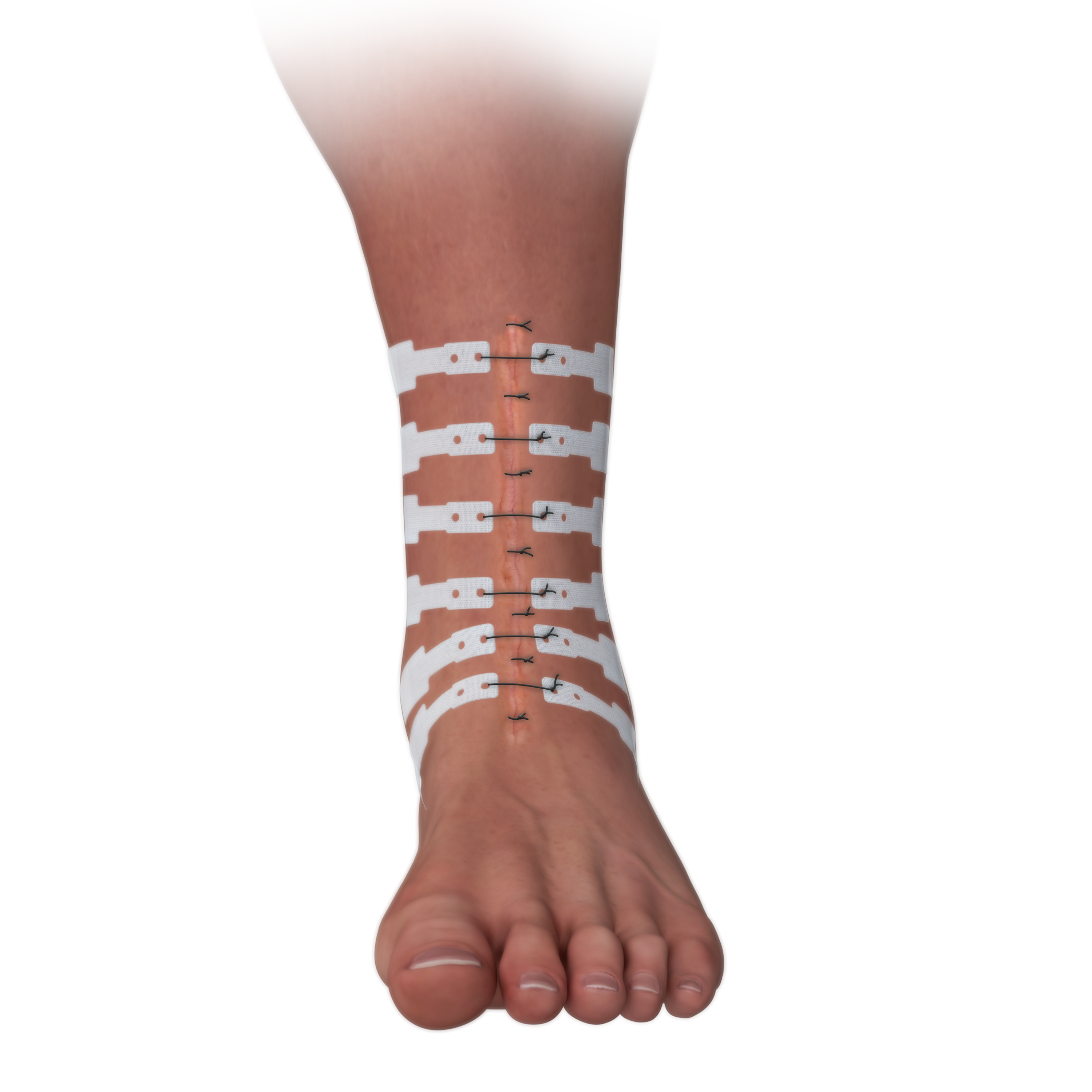 ASRD applied during total ankle replacement surgery