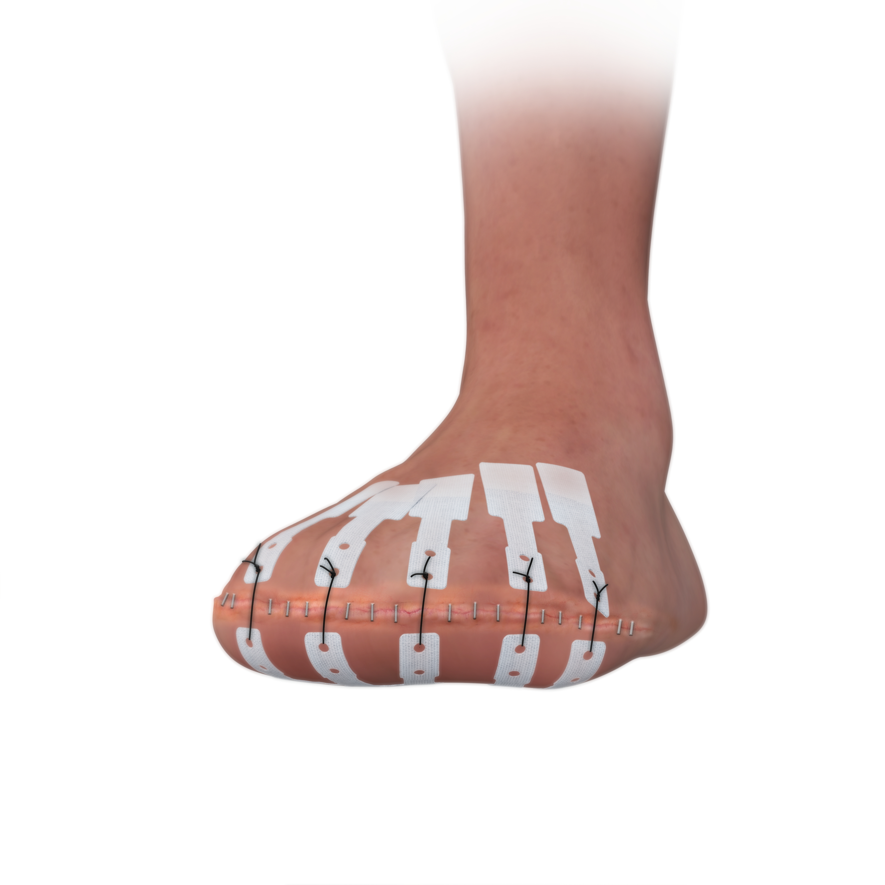ASRD applied during transmetatarsal amputation closure