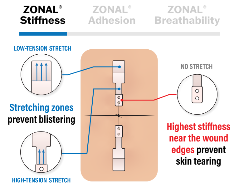 ZONAL® Stiffness diagram — low-tension stretching zones at the ends prevent blistering while the highest stiffness near the wound edges prevents skin tearing.